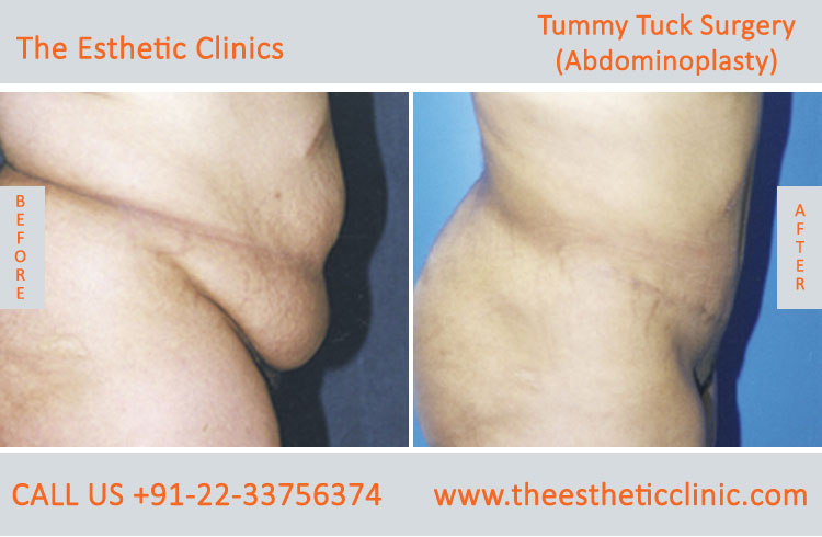 Tummy Tuck Surgery, Abdominoplasty before after photos in mumbai india (1)